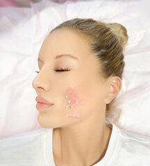  thread-lift procedure for facial rejuvenation