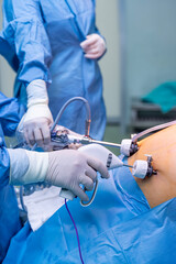 Doctor performing surgery, laparoscopic sleeve surgery, selective focus. Portrait of gastric bypass...