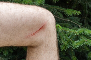 a deep bloody scratch on the skin of a man's hairy leg against the background of green spruce...