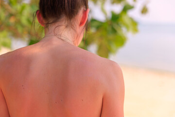 A person with sunburn on their back enjoys a warm day at the beach. The sun shines brightly while...
