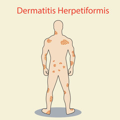 Dermatitis herpetiformis vector illustration showing itchy, blistering rash on elbows, knees, and buttocks; highlights gluten sensitivity and similarities to eczema and psoriasis.icon