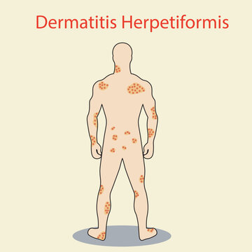 Dermatitis herpetiformis vector illustration showing itchy, blistering rash on elbows, knees, and buttocks; highlights gluten sensitivity and similarities to eczema and psoriasis.icon