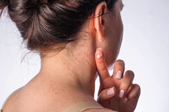 Medicinal anti-inflammatory cream for eliminating rashes and pimples on the skin of the body, close-up