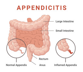 Illustration of an inflamed appendix as seen in appendicitis, showing its location in the human digestive system, as well as an image of a normal appendix.