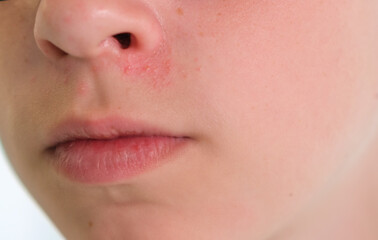 Fototapeta premium A young boy with a red nose, Seborrheic dermatitis, Medical Concept