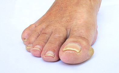 Callus in toe