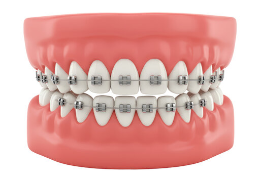 Isolated 3D Render of Human Jaws with Dental Braces for Orthodontics