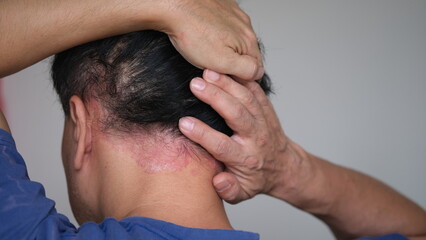Psoriasis on the nape of a man. Skin with psoriasis.