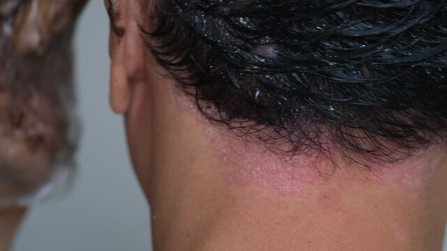 Is it permissible to dye hair on a scalp that is suffering from Psoriasis?