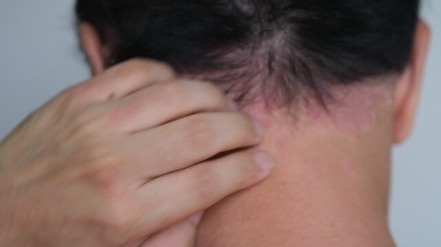 Psoriasis on the nape of a man. Skin with psoriasis.