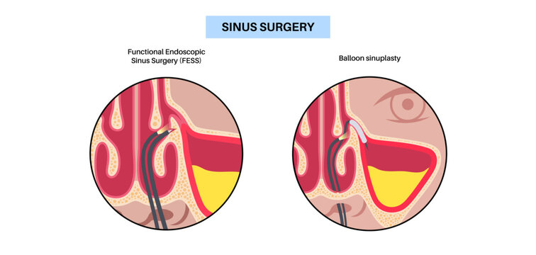 Minimally invasive endoscopic procedures