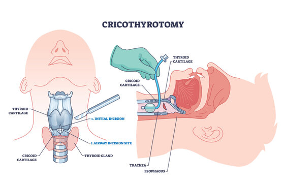 Cricothyrotomy procedure diagram shows incision, airway, and anatomical landmarks for emergency airway access. Outline diagram
