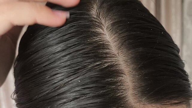 Close up of woman with dirty and greasy hair. Oily hair problem. Dandruff on a woman's black hair. Trichology.