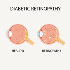 Vector illustration of diabetic retinopathy showing symptoms like blurred vision, dark spots, and vision loss. Includes comparison with similar eye diseases like macular degeneration con