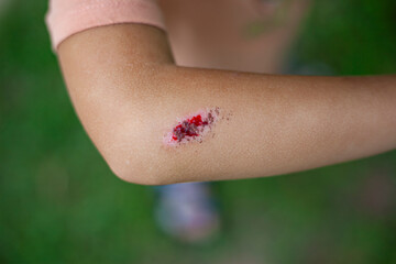 Children injury. Deep scratches on the skin of the children's elbow hand. Wounds, scratches,...