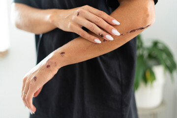 An injured arm displaying various bruises and scratches in an indoor setting, captured beautifully