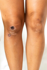 A closeup image shows bruised knees, highlighting skin textures and details in depth
