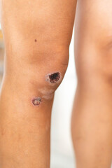 Detailed Closeup of an Injured Knee Featuring Significant Abrasions and Discoloration