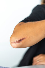 Injury on the Elbow with a Blood Stain Present as Result of an Accident During a Sports Activity