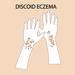 Vector illustration of discoid eczema showing round, itchy, scaly patches. Highlights symptoms and helps distinguish from similar conditions like ringworm and psoriasis icon