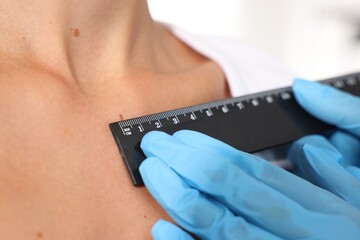 Doctor examining young woman's mole with ruler on white background, closeup