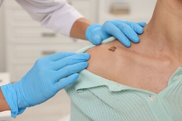 Doctor examining young woman's mole in hospital, closeup