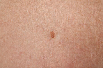 Woman with mole on her body, closeup