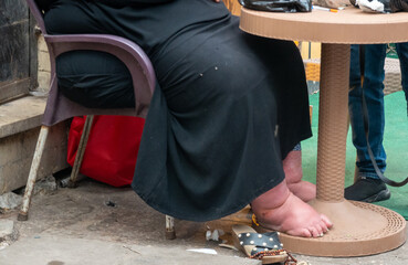 Woman with foot and leg problems who is sitting barefoot at a table in the street.