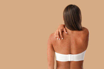 Young woman ill with chickenpox on beige background, back view