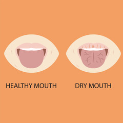 Vector illustration of dry mouth, showing thirst, sticky saliva, bad breath, cracked lips, and sore throat; highlights similar conditions like dehydration, Sjögren’s syndrome, diabetes.icon