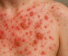 High-resolution close-up photo of human skin affected by bacterial infection impetigo. The image shows inflamed red patches, small blisters, and yellowish-brown crusts typical of this contagious skin 