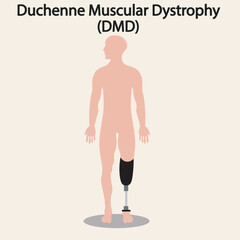 Vector showing Duchenne muscular dystrophy: progressive muscle weakness, calf enlargement, gait issues. Highlights symptoms vs similar disorders like Becker MD and limb-girdle MD leg, disability