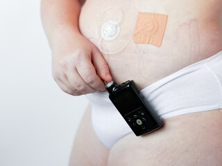 Adult caucasian female using insulin pump for diabetes management