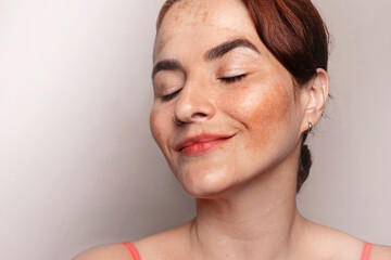 Woman smiles and likes her face with pigmentation, melasma, freckles, age spots photo. Close up photo