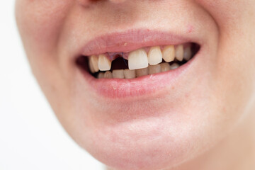 Young woman smiling without a front tooth. Implant placement surgery. front tooth extraction, bone...