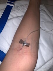 Intravenous catheter in patient arm, hospital medical treatment and healthcare procedure close up background with copy space