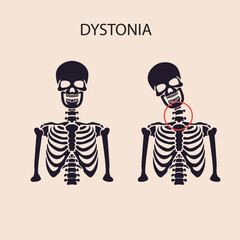 Vector showing dystonia: involuntary muscle contractions, twisting, tremors, abnormal postures; compared with Parkinson’s, tremor disorders, cerebral palsy. silhouette skeleton