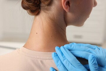 Doctor examining young woman's mole in hospital, closeup