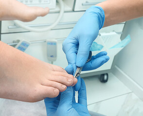 Medical pedicure. The patient's nails are trimmed by a podologist using nail clippers. Vertical photo.