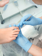 Podologist cleans the patient's nail with a curette. Patient undergoing treatment for ingrown nail. Podology and Orthopedics Clinic.