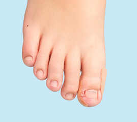 Human toes. Thumb with a titanium plate to align the nail after surgery to remove an ingrown nail