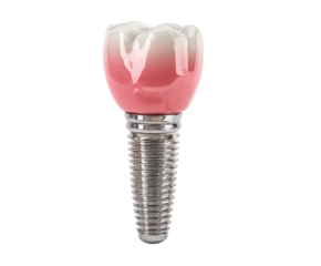 Dental implant design for restorative dentistry and oral health on a transparent background, cut out