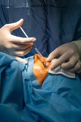 Eyelid surgery in the operating room. Plastic surgery operation, modifying the eye region in...