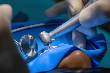 Close-up view of a dental treatment with a rubber dam in place. Multiple tools and gloved hands...