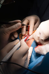 Close up of the face of a patient who is undergoing blepharoplasty. The surgeon cuts the eyelid and...