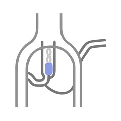 Medical schematic illustration of coronary artery bypass grafting CABG