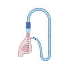 Medical Diagram Showing Dialysis Procedure with Blue Tubing System