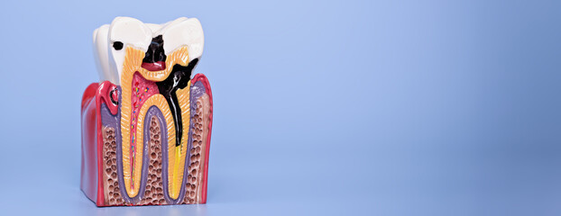 Dental model displaying advanced tooth decay