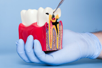 Close-up of a gloved hand holding a dental model showing advanced tooth decay, with dental tool pointing to the cavity.