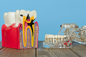 Tooth decay model and dental examination on jaw model